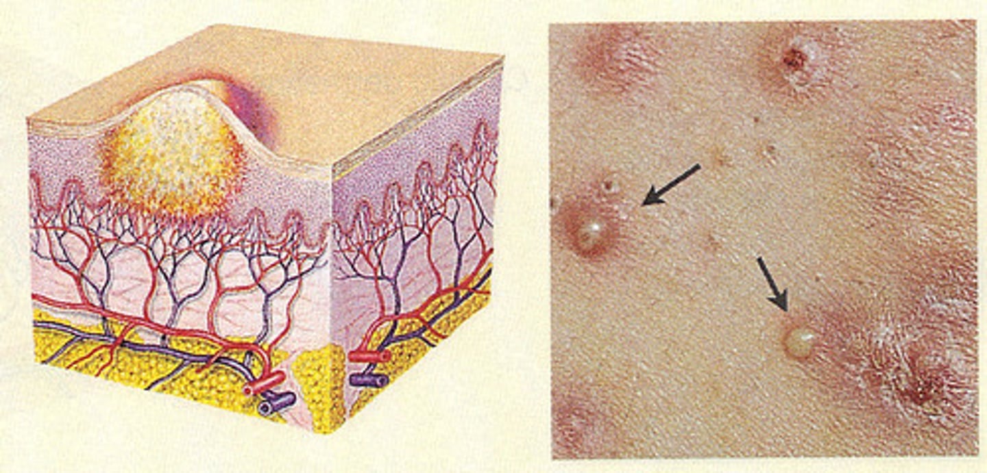 <p>vesicle containing pus</p>