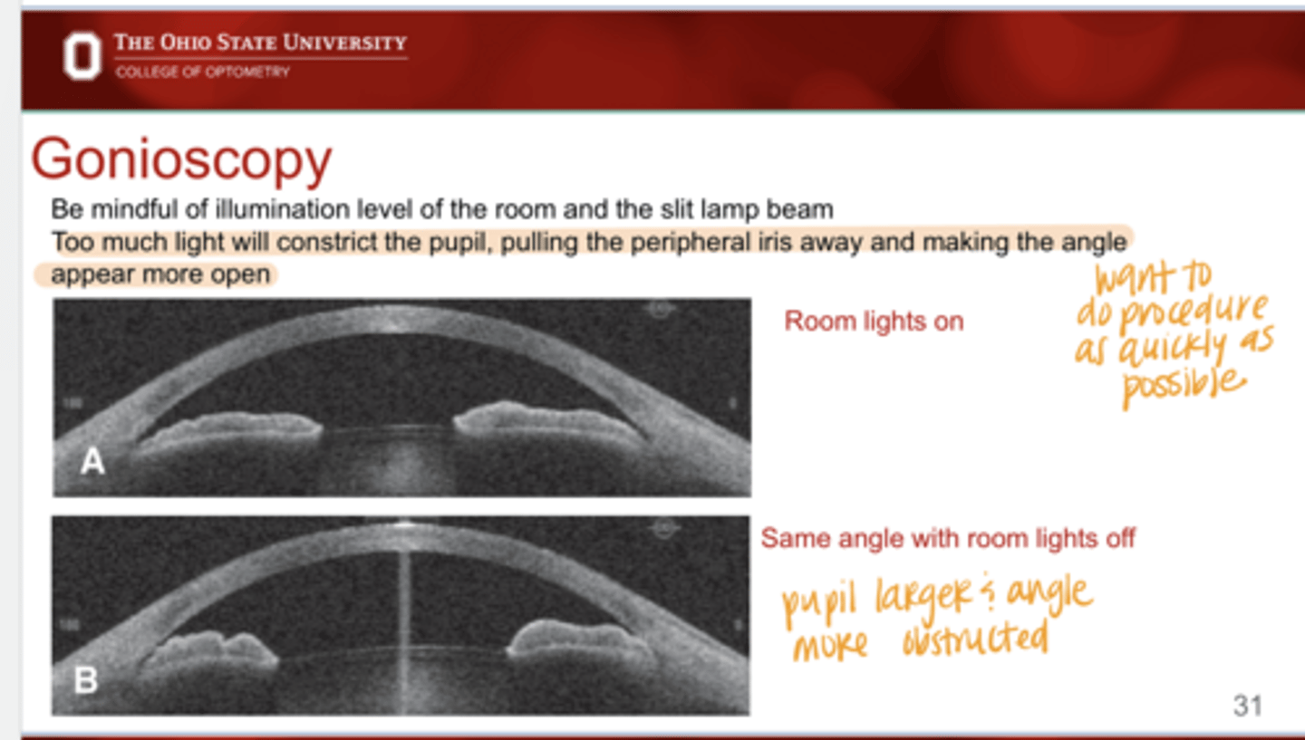 <p>Why should you be mindful of illumination of the room and slit lamp beam when doing gonioscopy?</p>