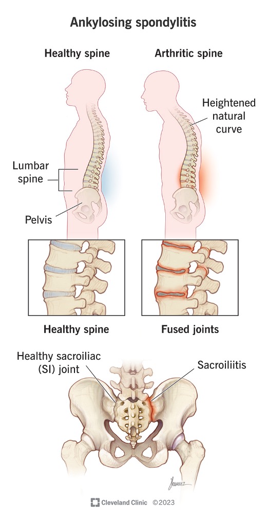 <ul><li><p><span>Inflammatory condition in spine</span></p></li><li><p><span>Fusion of skeletal structures</span></p></li><li><p><span>Begins in SI joint and progresses into vertebrae</span></p></li><li><p><span>Significant mobility limitations of spine and pain</span></p></li></ul><p></p>