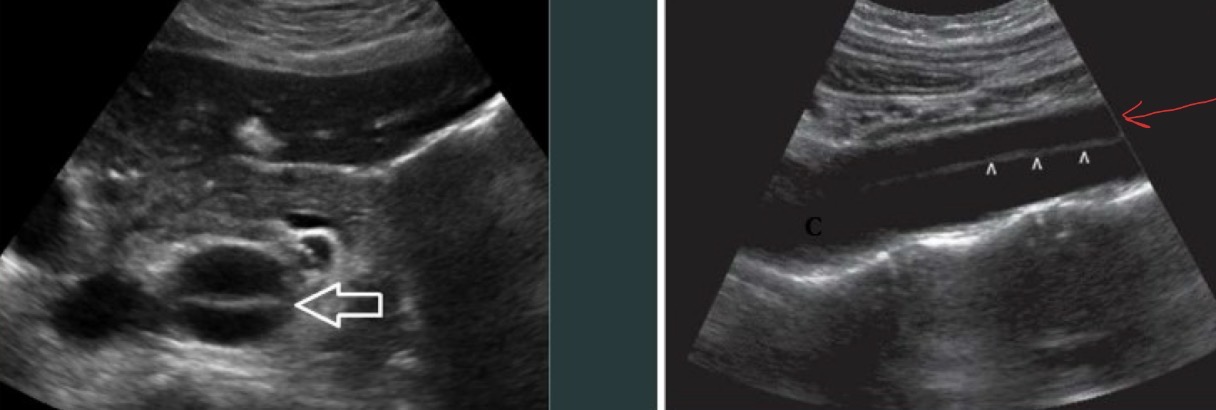 <p><span>A thin echogenic linear intimal flap within the lumen.</span></p>
