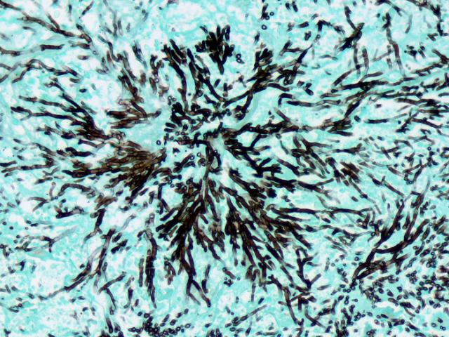 <p><em>Newcomer Supply. (n.d.). Fungus, Grocott methenamine silver stain [Photomicrograph].</em></p>