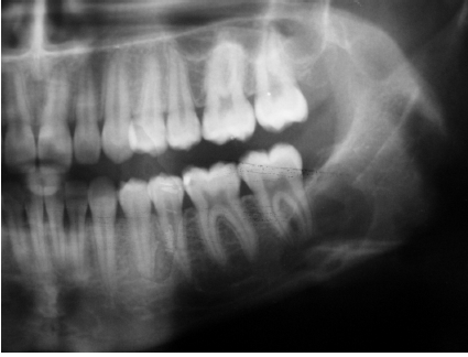 <p>traumatic bone cyst (simple bone cyst)</p>