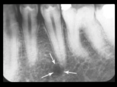 <p>mental foramen</p>