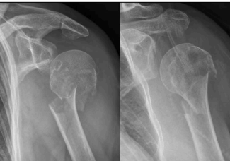 <p>Fracture of the surgical neck of the humerus</p>