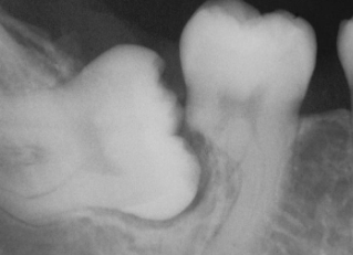 <p>common in apical/ mid root; associated with cysts, tumors, ortho, excessive occlusal stress, reimplantation of avulsed tooth  </p>