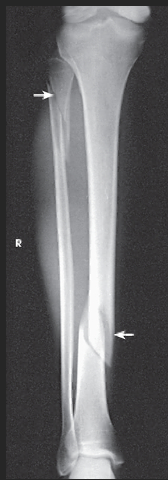 <p>What anatomy is placed parallel to the IR?</p>
