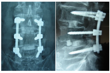 <p>Fuses 2 or more vertebral bodies together, to restrict spinal motion and remove the source of mechanical back pain to relieve symptoms</p><p><u>Indication</u>:</p><ul><li><p>Trauma, tumor, segmental degeneration, spondylolisthesis, spondylolysis, deformity, DDD, recurrent disc herniation</p></li></ul><p><u>Contraindications</u>: Severe deconditioning/multimorbidity</p><p><u>Post Operation: </u>Indep mobility, indep ADLs, limited lifting</p><p><u>Complications</u>: Pseudoarthrosis (poor/incorrect bone fusion)</p>