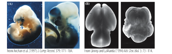 <p>•disrupted regional differentiation of the forebrain, improper development of cerebral hemispheres (incomplete seration </p><p>•1 in 16,000 live births and most common malformation of the forebrain known</p><p>•Cyclopia – development of a single eye</p><p>•Range of severity from mild to still birth – responsible for 1 in 250 still births</p>