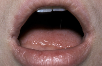<p>mucosal invagination that occur at the corners of the mouth on the vermillion border, not associated with facial or palatal clefts, no tx required </p>