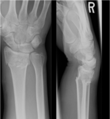 <p>transverse fracture of distal radius with dorsal angulation</p>