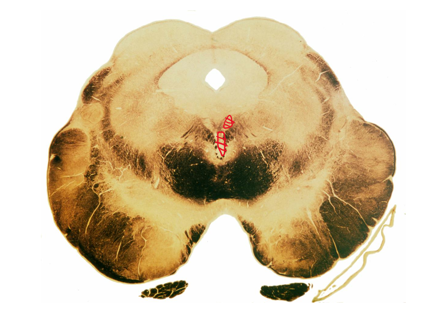 <p>Damage to the following nuclei highlighted in red will result in what kinds of damage? </p>