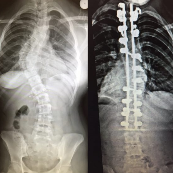 <ol><li><p><span style="color: rgb(218, 81, 81);"><strong>bracing</strong></span>: slows curvature</p></li><li><p><span style="color: rgb(47, 131, 187);"><strong>surgery: spinal fusion</strong> w/ rod placement</span> if severe (<strong>>45 degrees)</strong></p></li></ol><p></p><p></p><p></p>