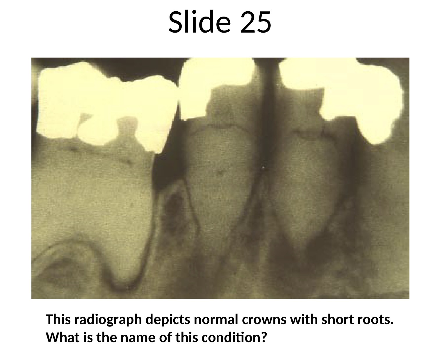 <p>normal crowns, short roots no pulp. incomplete or no pulp chambers</p>