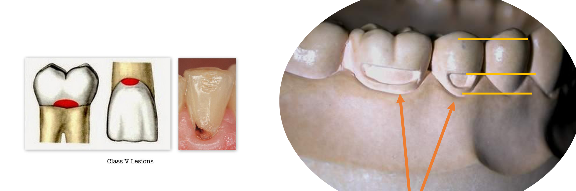 <p>Smooth surfaces of all teeth in gingival 1/3 of facial and lingual surfaces Class V </p>