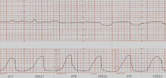 <ul><li><p><span style="color: yellow;">Bishop score of 5 or less</span></p><ul><li><p><span style="color: yellow;">Prostaglandins- promotes cervical ripening and contractions</span></p></li><li><p><u>Dinoprostone (Cervidil, etc.)</u></p><ul><li><p><span style="font-family: "Avenir Next LT Pro";">Directly softens cervix</span></p></li><li><p><span style="font-family: "Avenir Next LT Pro";">Cervical insert</span></p></li></ul></li><li><p><u>Oxytocin (Pitocin)</u></p><ul><li><p><span style="font-family: "Avenir Next LT Pro";">Uterotonic Agent- very popular!</span></p></li><li><p><span style="font-family: "Avenir Next LT Pro";">IV:POTENT</span></p></li><li><p><span style="font-family: "Avenir Next LT Pro";">No placental crossing</span></p></li><li><p><span style="font-family: "Avenir Next LT Pro";"><strong>Watch out for uterine hyperstimulation = FHR!!</strong></span></p><ul><li><p><span style="font-family: "Avenir Next LT Pro";"><strong>Tachysystole more than 6 contraction in 10 min period not enough resting tone for good placental perfusion, maternal exhaustion.</strong></span></p></li><li><p><span style="font-family: "Avenir Next LT Pro";"><strong>Stop Pitocin</strong></span></p></li></ul></li><li><p><span style="font-family: "Avenir Next LT Pro";">10 units/1 L of isotonic solution, titrated to achieve stable contractions every 2 to 3 minutes lasting 40 to 60 seconds</span></p></li><li><p><span style="font-family: "Avenir Next LT Pro";">1cm/hr dilation progress is good!</span></p></li></ul><ul><li><p><u>Misoprostel (Cytotec)</u></p><ul><li><p><span style="font-family: "Avenir Next LT Pro";">Prostaglandin and Uterotonic</span></p></li><li><p><span style="font-family: "Avenir Next LT Pro";">Not as potent as oxytocin</span></p></li><li><p><span style="font-family: "Avenir Next LT Pro";">Ripens cervix</span></p></li><li><p><span style="font-family: "Avenir Next LT Pro";">Oral, vaginal, rectal</span></p></li><li><p><span style="font-family: "Avenir Next LT Pro";">Can also cause uterine overstimulation</span></p></li></ul><p></p></li></ul></li></ul></li></ul><p></p>