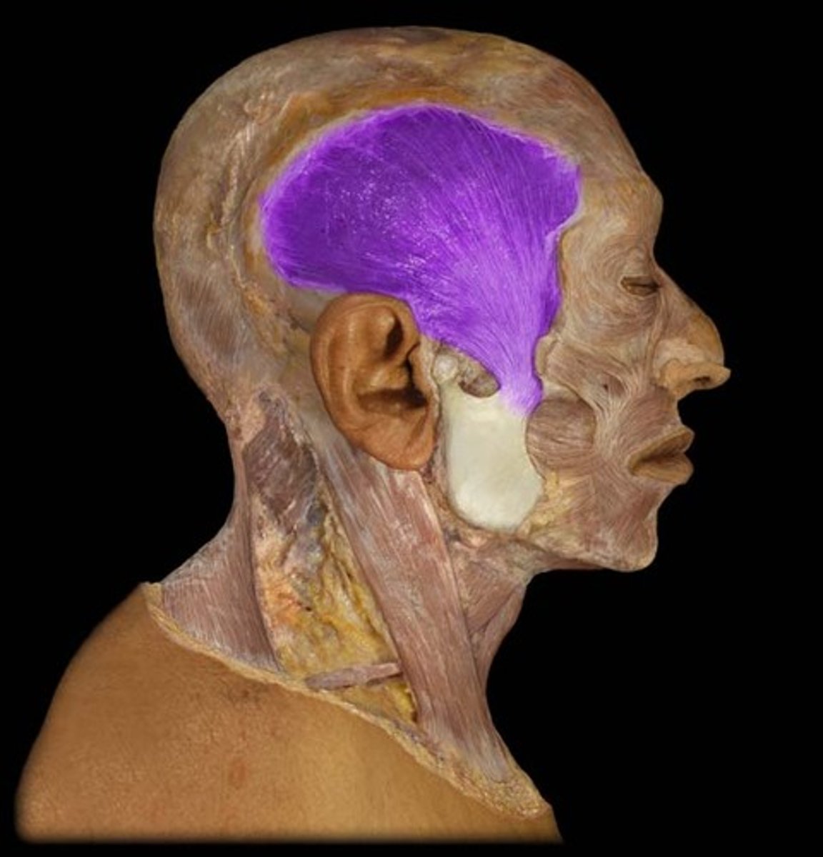 <p>Region:</p><p>Head</p><p>Action:</p><p>Elevates &amp; retracts mandible</p><p>Innervation:</p><p>CN V3</p>