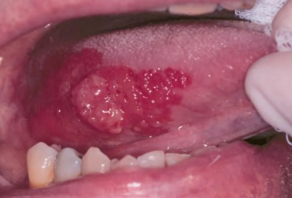 <p>What is this lesion?</p>