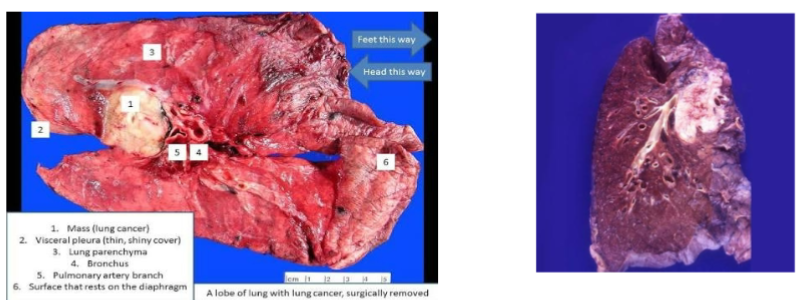 <p>Pneumonectomy</p>