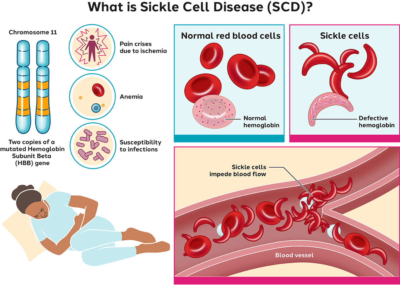 <p>genetic blood disorder where red blood cells turn sickle-shaped, blocking blood flow</p><ul><li><p>causes chronic anemia, severe pain, &amp; organ dmg</p></li></ul><p></p>