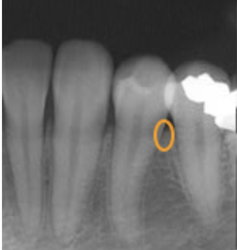 <p>cementoenamel junction</p>