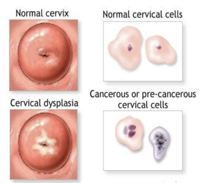 <p>1) cells mature abnormally within a tissue such that cells vary in size, shape, and organization</p><p>2) Large nuclei</p><p>3) increased rate of mitosis</p><p>4) Causes: </p><ul><li><p>chronic irritation</p></li><li><p>pre-cancerous change</p></li></ul><p></p>