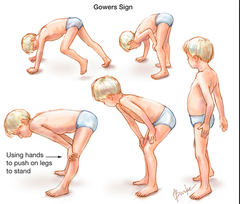 <p>MD --> lack of hip/thigh muscle strength --> use arms to push on legs to stand up</p>