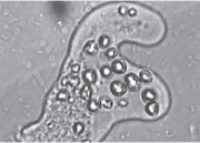<p><strong>Amoebic dystentry </strong>is a disease caused by <strong>entamoeba histolytica</strong></p>