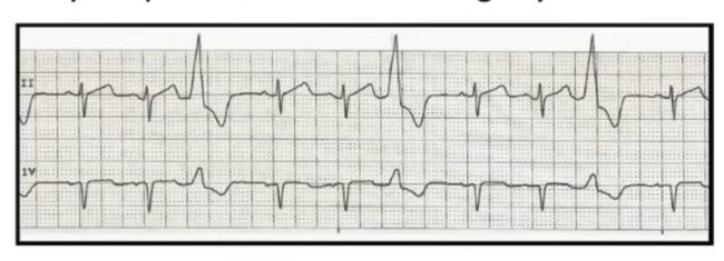 <p>Treat ventricular dysrhythmias</p><ul><li><p>Ventricular fib.</p></li><li><p>V-Tach</p></li><li><p>Pulseless V-Tach</p></li></ul><p></p>
