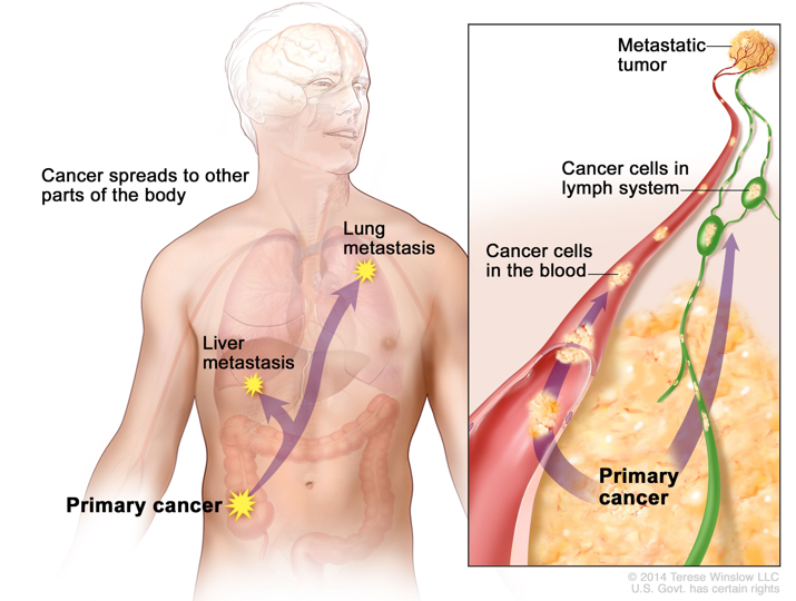 <ul><li><p>Wandering cancerous cells establish secondary tumors </p><ul><li><p>Develop in other locations in the body </p></li></ul></li><li><p>Cancerous cells break free from the primary tumor </p></li><li><p>Transported in the lymph</p></li><li><p>End up in the Brain, Bones, Liver, and Lungs!</p></li></ul><p></p>