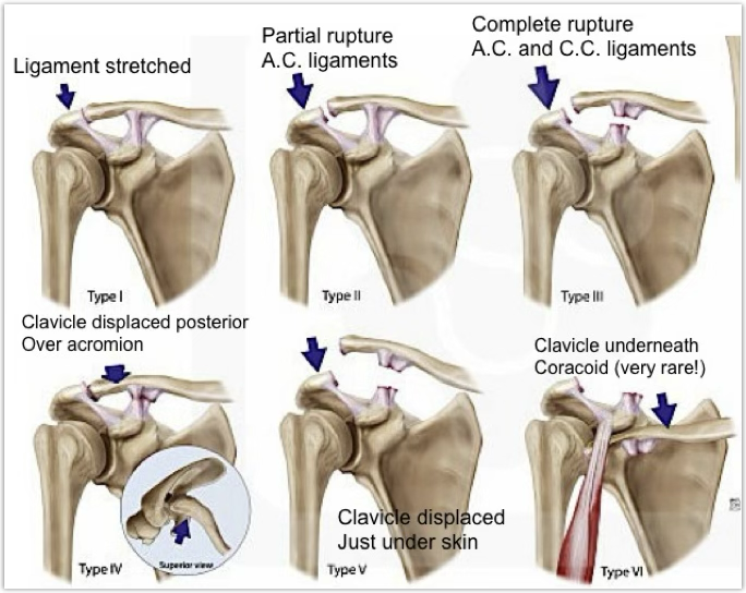 <p>how does an AC sprain occur?</p>