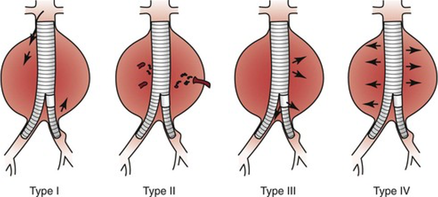 <p>categories of endoleaks</p>