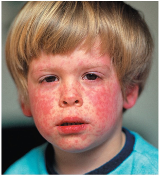 <ul><li><p><span style="font-size: calc(var(--scale-factor)*12.00px);">Cold-like symptoms, macular rash, Koplik’s spots</span></p></li><li><p><span style="font-size: calc(var(--scale-factor)*12.00px);">Infected individual sheds virus for several days before</span><br><span style="font-size: calc(var(--scale-factor)*12.00px);">symptoms appear</span></p></li><li><p><span style="font-size: calc(var(--scale-factor)*12.00px);">Transmitted by the respiratory route</span></p></li></ul><p></p>