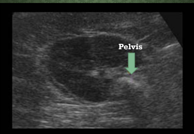 <p>What structure is identified in the center of the kidney on this image?</p>