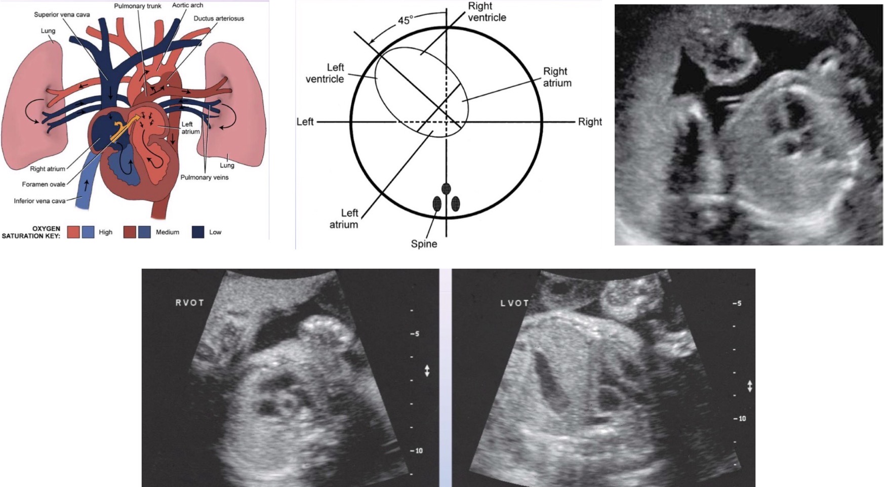 <p>2 unique features unique to fetal heart</p><ul><li><p>Foramen ovale: opening between atria of heart and allows blood to move from right to left atrial chamber</p></li><li><p>Ductus arteriosus: connects pulmonary artery and aorta and allows blood to move from pulmonary artery to aorta; closes at/shortly after birth</p></li></ul><p>Axis of heart should be tilted approx. 45 degrees to anteroposterior axis of fetal thorax and pointed to left (second image)</p><p>4-chambered view of fetal heart may be seen as early as 15 weeks; chambers should appear anechoic and relatively symmetric, divided by bright atrioventricular septa (should be “broken” only as foramen ovale)</p><p>4th image is fetal heart outflow tracts</p>