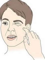 <p>Tapping patient's facial nerve prompts brief facial spasm</p>