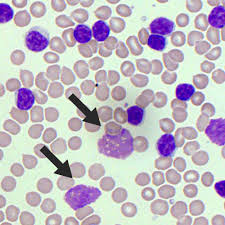 <p>smudge cell</p>