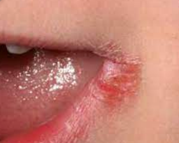 <p>cracks at the corners of the mouth</p><p>often due to decreased vertical dimension or fungal infection</p>