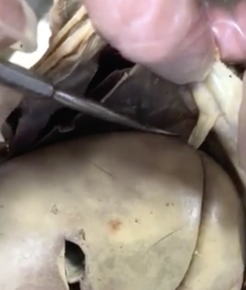 <p>what is the “white string” structure near liver prong is pointing to</p>