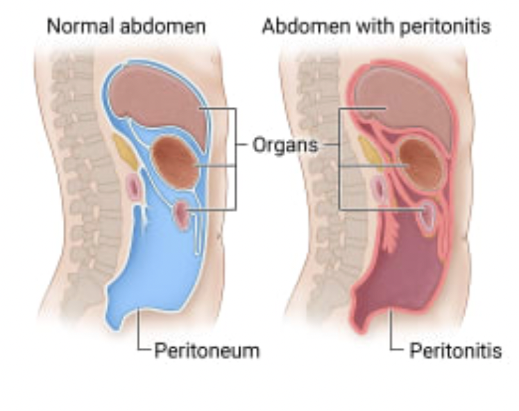 <p>What are complications of Peritoneal Dialysis</p>