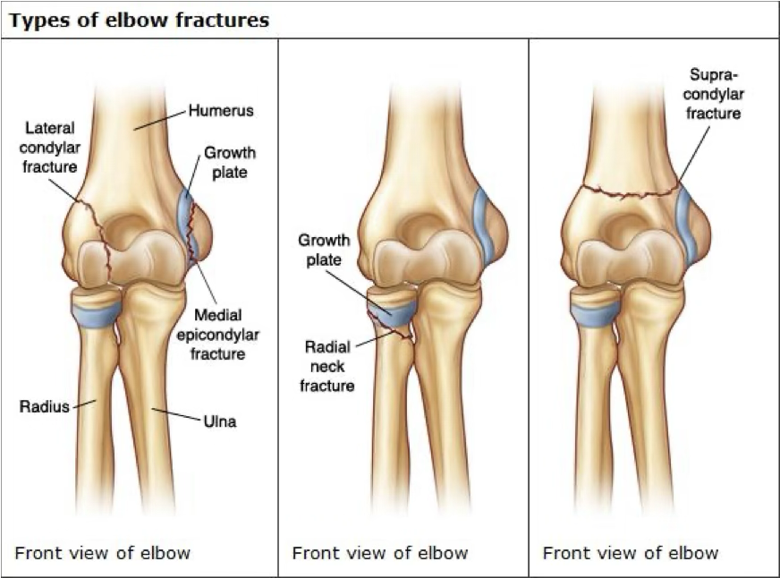 <p>treatment of elbow fracture</p>