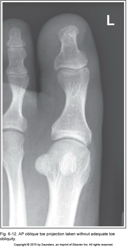 <p>AP oblique toe</p>