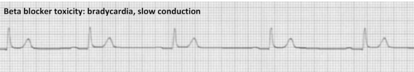 <ul><li><p><strong>Decrease sympathetic tone</strong></p></li><li><p>Block myocardial beta-adrenergic receptors</p></li><li><p>Prevent binding of norepinephrine/epinephrine</p></li><li><p>Impact SA node, AV node, blood pressure</p></li><li><p>"Lol" drugs: esmolol, metoprolol, propranolol...</p></li></ul><p></p>