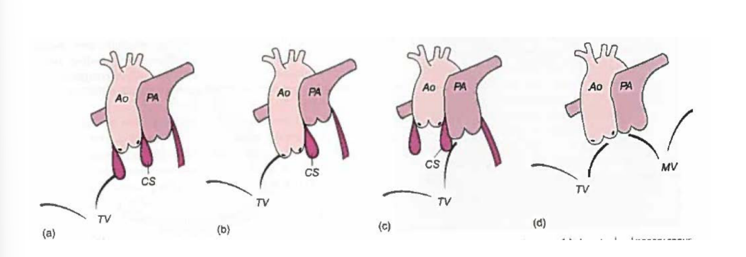<ol><li><p>Bilateral conus <strong>2 muscular sleeves under both the pulmonary valve and aortic valve</strong>. It occurs in about <strong>23%</strong></p></li><li><p>Absent aortic conus</p></li><li><p>Absent subpulmonary conus</p></li><li><p>Bilateral absent conus</p></li></ol><p>(if conal tissue is malformed it can cause obstruction - most common PS)</p>