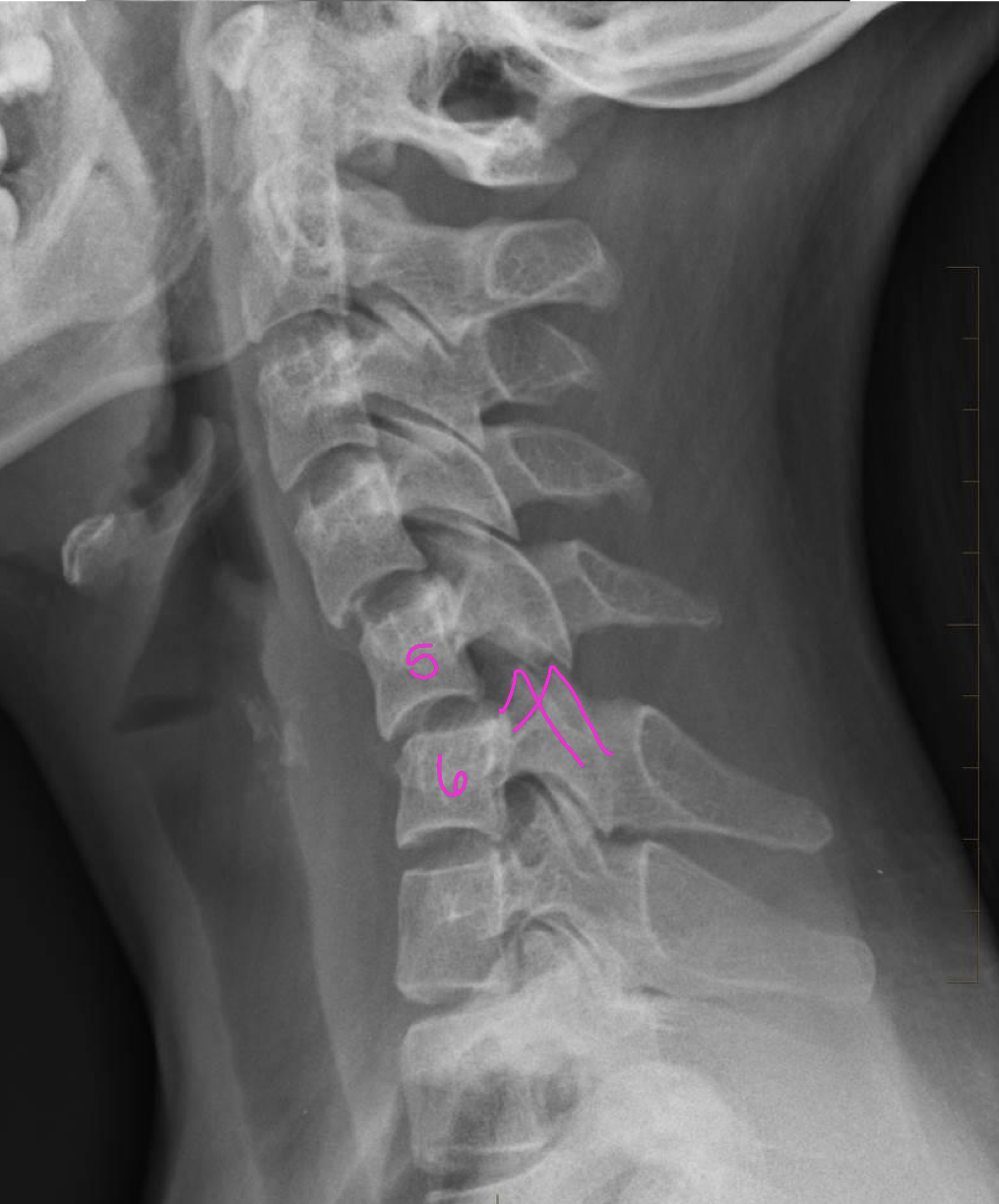 <p>What are the findings of a Bilateral facet dislocation</p>