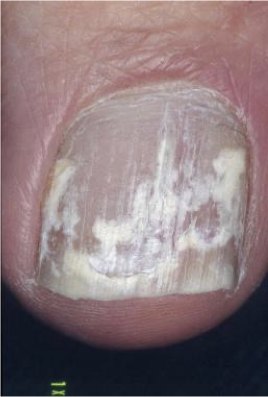<p>Physical examOnychomycosis</p>