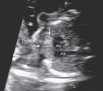 <p>thymus gland (anterior to the great vessels and SVC with high frequency imaging)</p>
