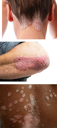 <p></p><ul><li><p>Chronic persistent, relapsing, scaling skin condition</p></li><li><p><strong>Sharply marginated </strong>(clear border)<strong> , red plaques with </strong><span style="color: red;"><strong>silvery scales</strong></span></p></li><li><p>can see associated <strong>arthritis</strong></p></li><li><p><strong>EX: </strong>lichen simplex chonicus, seborrheic dermatitis</p></li></ul><p></p>