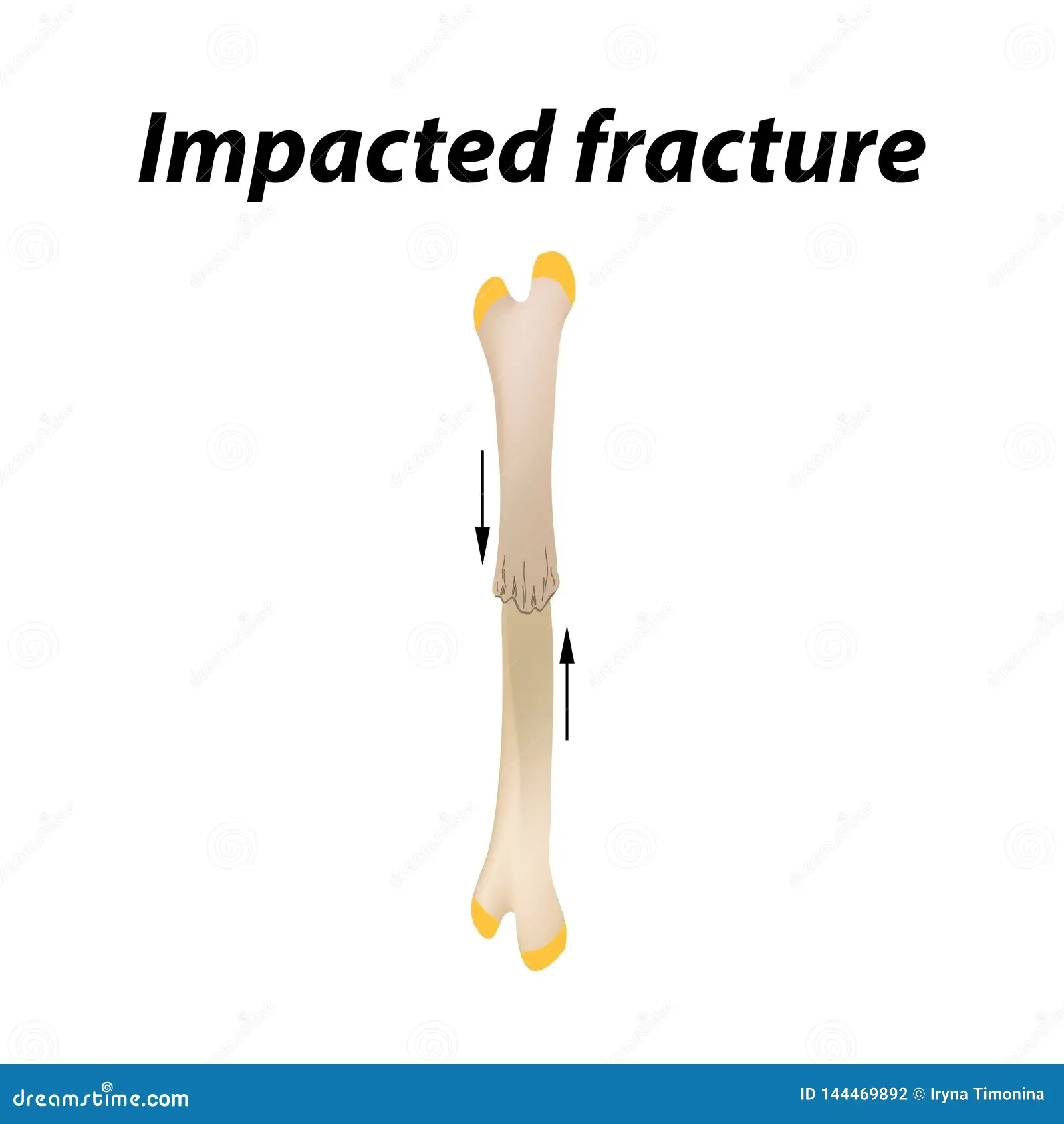 <p>ends of bone driven together </p>