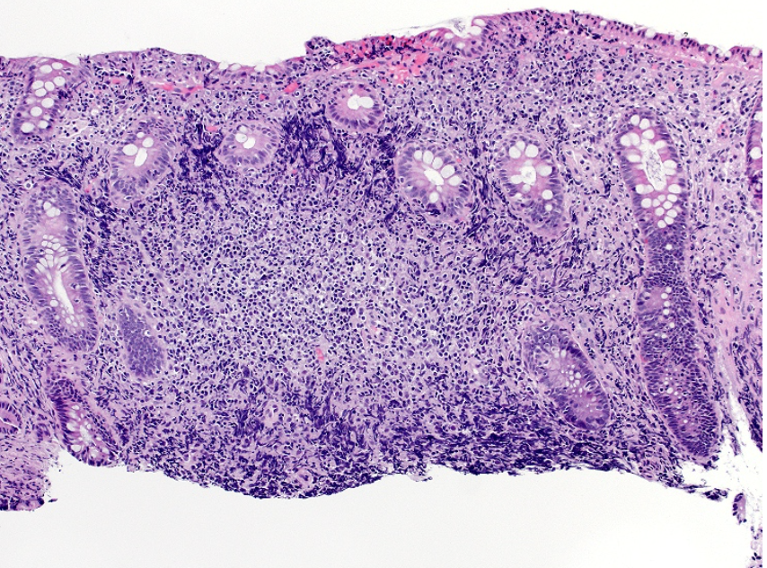 <p>Patient HIV avec lésions au niveau du rectum </p><p>1) diagnostic et étiologie</p><p>2) que faire en 1er lieu </p><p>3) Histologie</p>