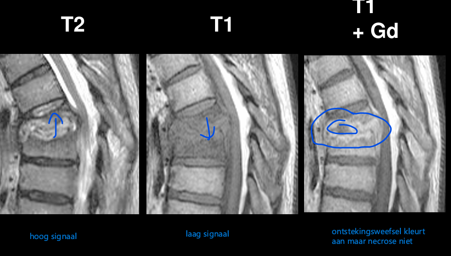 <p>MRI</p><ul><li><p>T2: hoog signaal (lichter)</p></li><li><p>T1: laag signaal (donkerder)</p></li><li><p>T1 + Gd: ontstekingsweefsel kleurt, necrose niet.</p></li></ul><p></p>